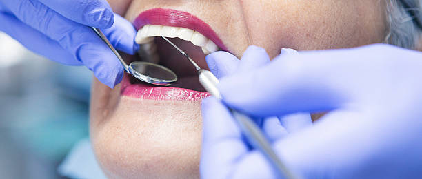 Best Knocked-Out Tooth (Avulsed Tooth) Treatment in Bessemer, MI